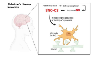 发现可以解释为什么女性更容易患阿尔茨海默氏症