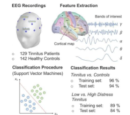 新的脑电图程序可准确测量耳鸣引起的不适